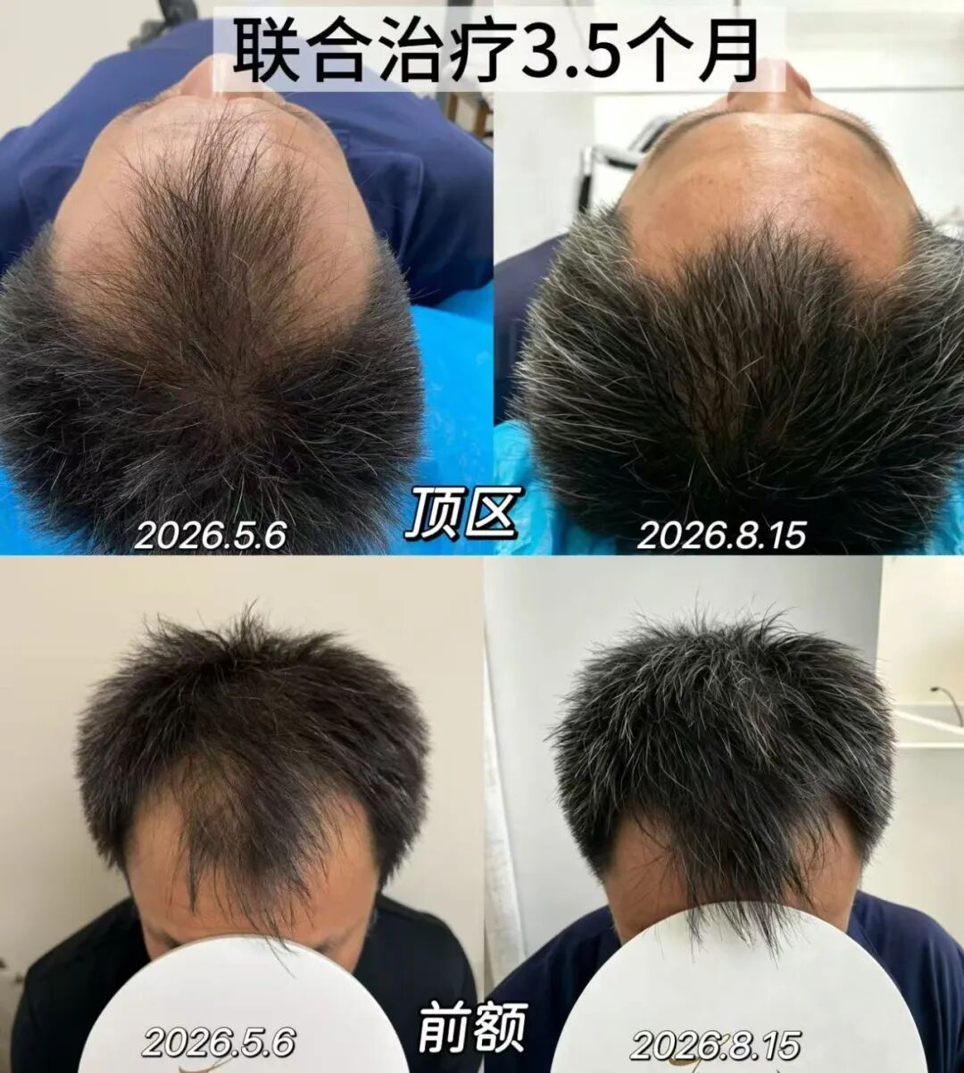 真实案例|42岁男士雄脱5-6级,3.5个月逆袭生发! 640 5ca5a01f