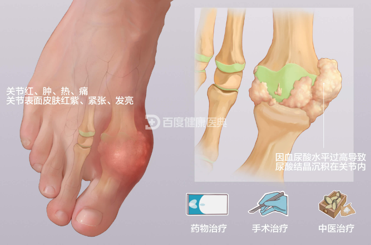 痛风石 "啃" 坏大脚趾,我院双源 CT+MDT 助 72 岁老人顺利除石! 640 Aa11dfe9